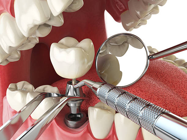 Best Knocked-Out Tooth (Avulsed Tooth) Treatment in Marthasville, MO
